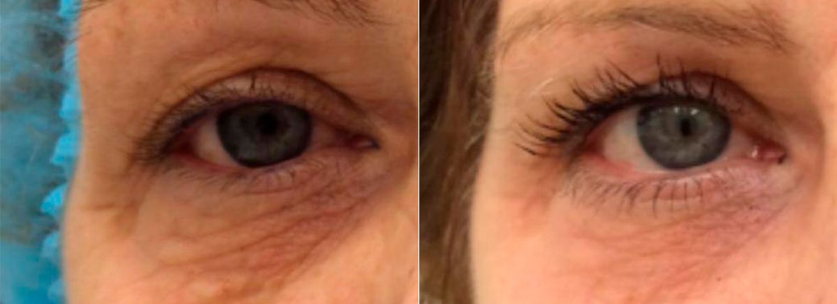 DOT-омоложение лица