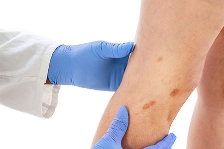 Как избавиться от пигментных пятен на руках