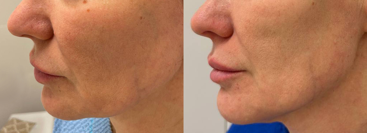 Ультраформер