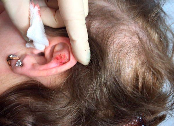 невус после