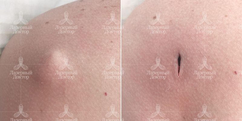 Удаление новообразований