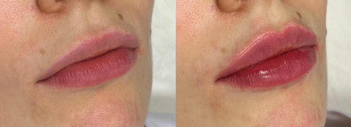 Контурная пластика губ 