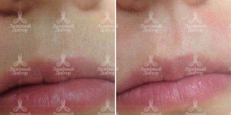 Лазерная эпиляция верхней губы