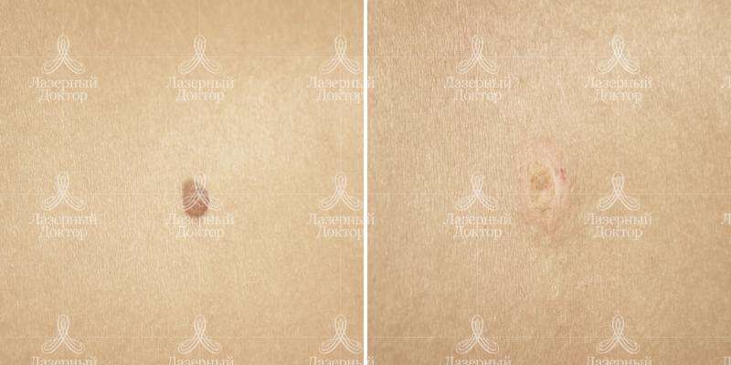 Лазерное удаление родинок: фото до и после