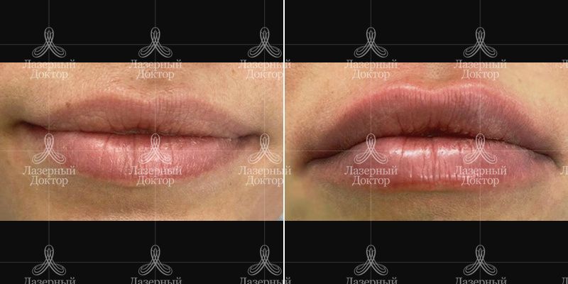 контурная пластика губ