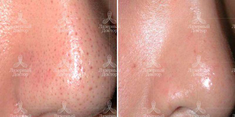 Лазерное карбоновое омоложение (фото)