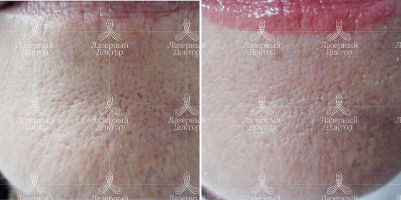 3d лифтинг infini - что это?