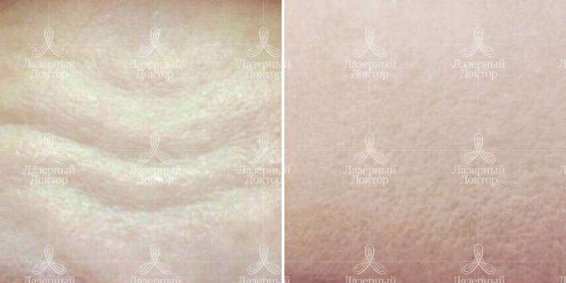 Инъекции Ботокса: фото до и после