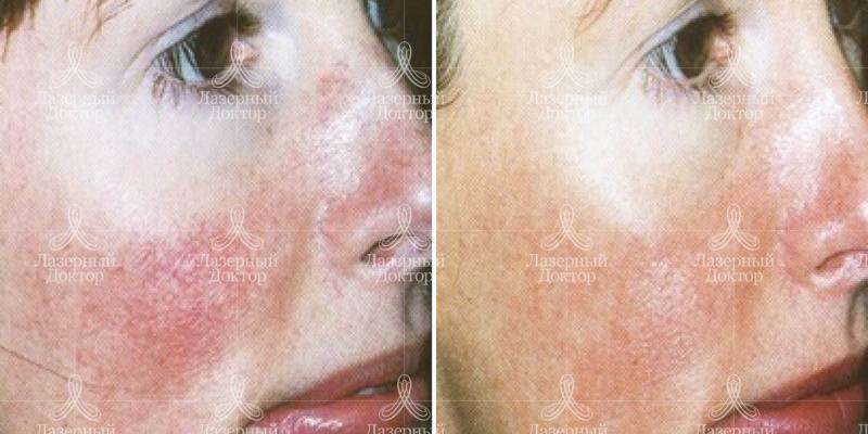 Процедура Квантум в СПб