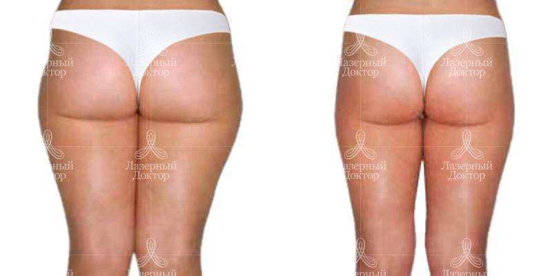 Процедура lpg: фото до и после