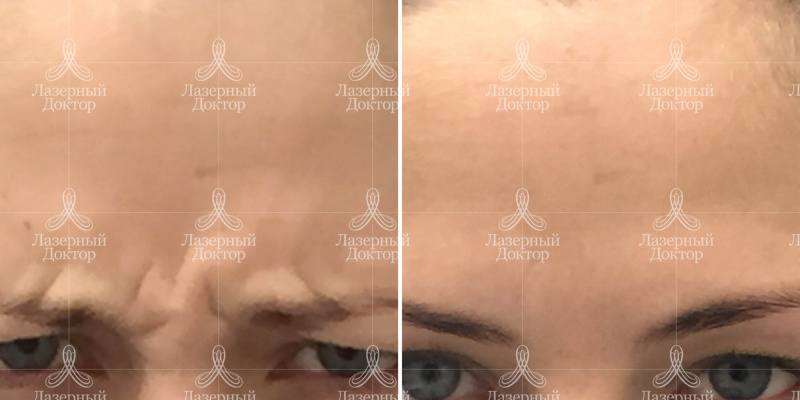 Уколы Ботокса в межбровную область