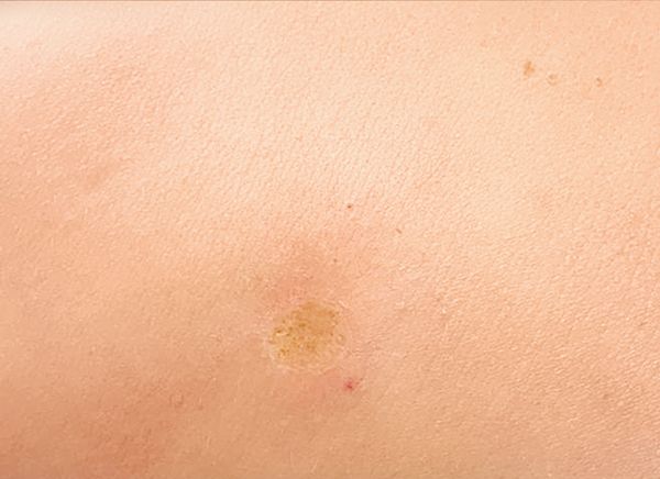 Удаление новообразований фото до и после