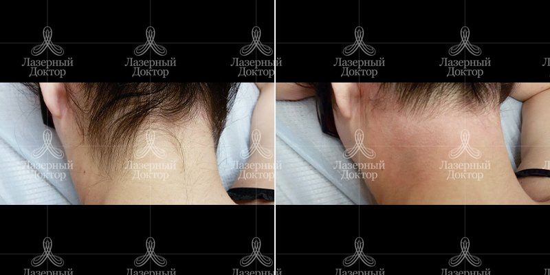 Лазерная эпиляция