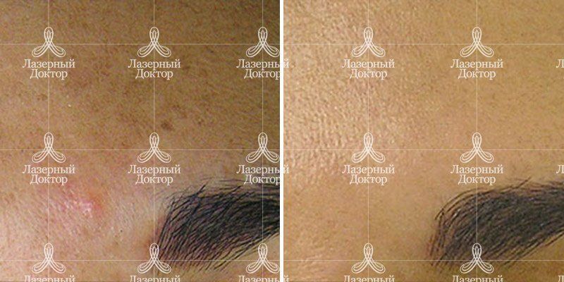 HydraFacial (фото)