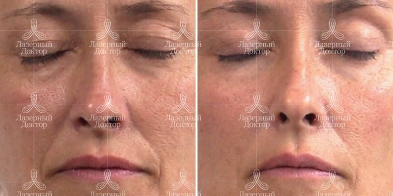 лпж массаж лица (фото до и после)