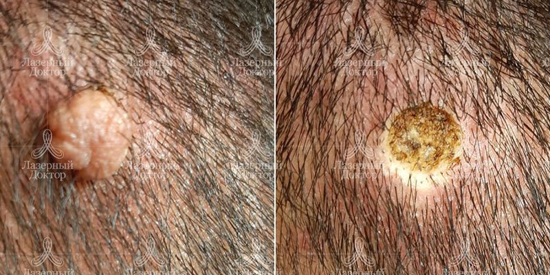 удаление новообразований