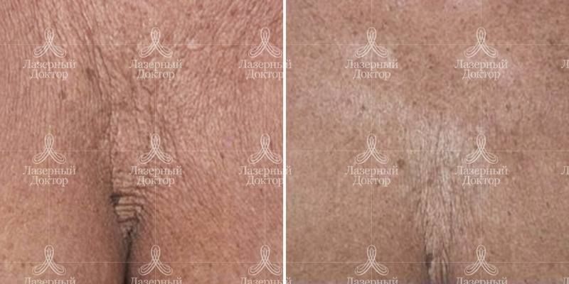 Результат химического пилинга в зоне декольте