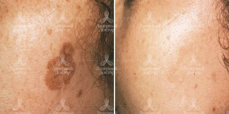 ipl quantum фотоомоложение щек