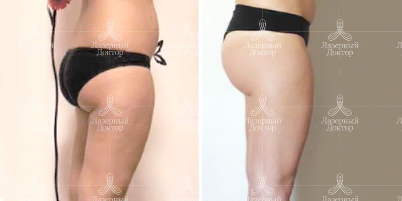 эндосфера процедура