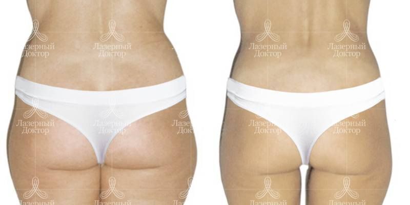 лпж массаж (фото до и после)