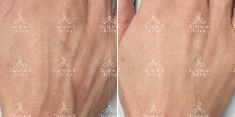 Фото до и после пластики рук филлерами