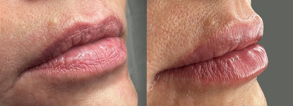 Контурная пластика губ 