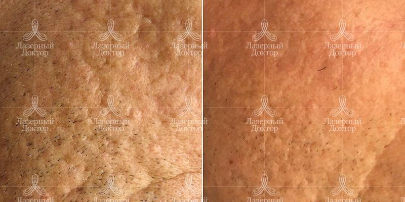 Удаление шрамов