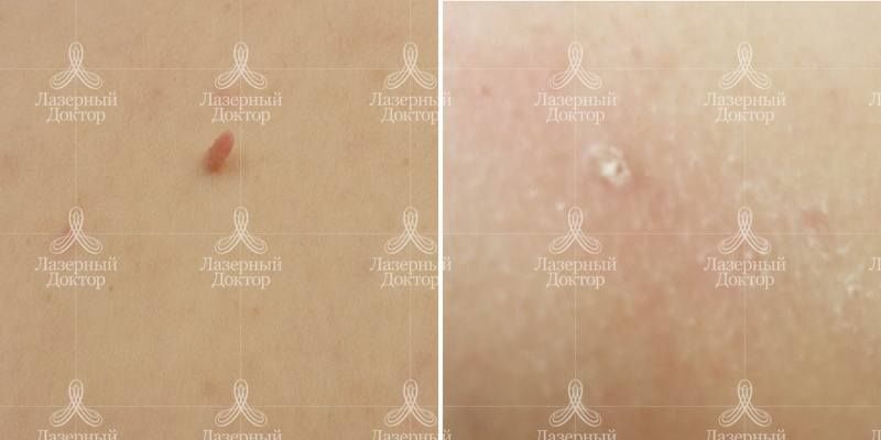 Лазерное удаление фибромы на теле