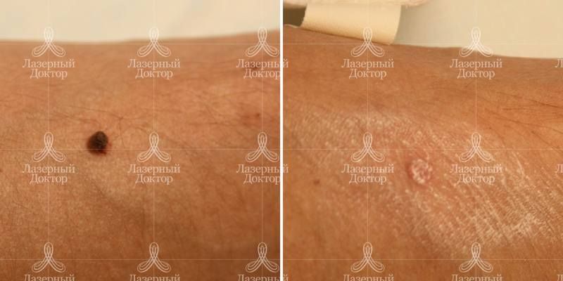 Родинка на руке: фото до и после иссечения лазером