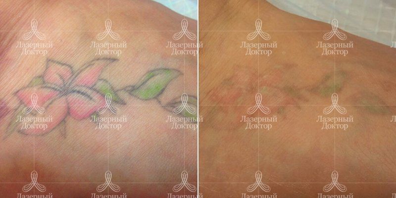 Удаление татуировки