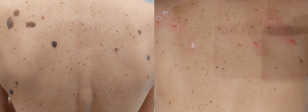 Удаление кератом