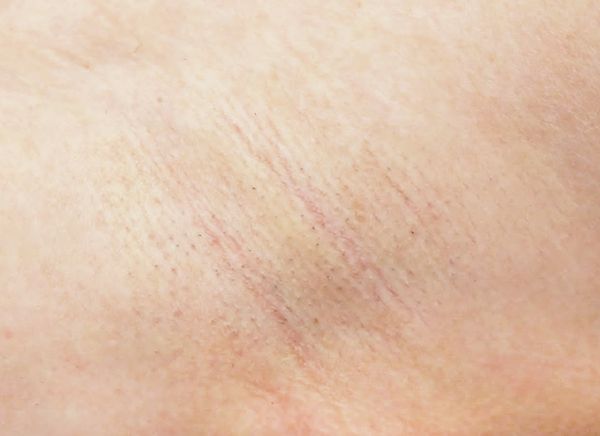 Лазерная эпиляция фото до и после