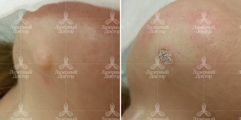 Лазерное удаление фибромы на подбородке