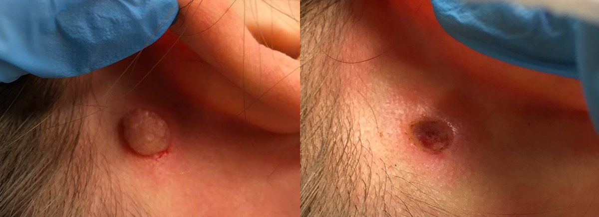 удаление новообразования