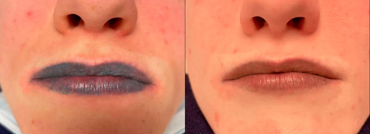 Лазерное удаление татуировок