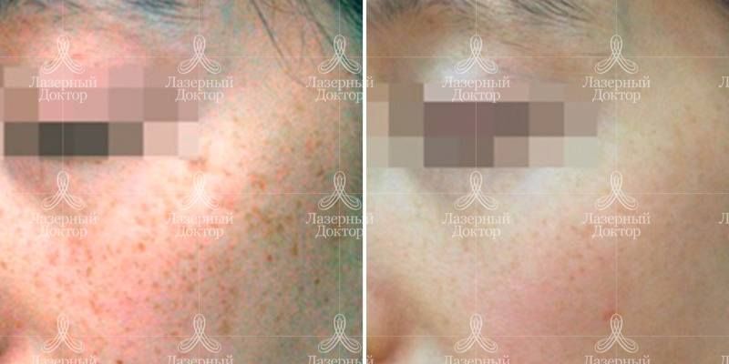 Удалить пигментные пятна на лице лазером