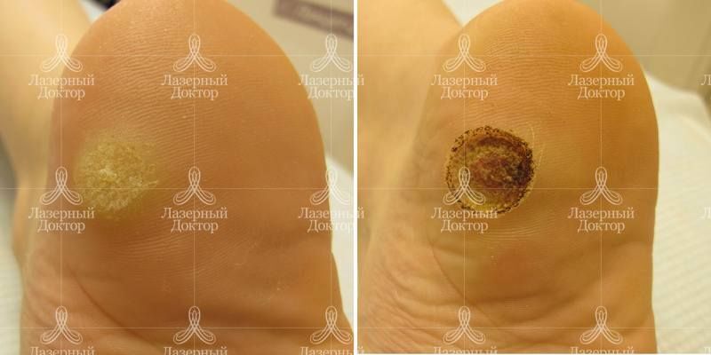 Удаление бородавки на стопе (фото до и после)