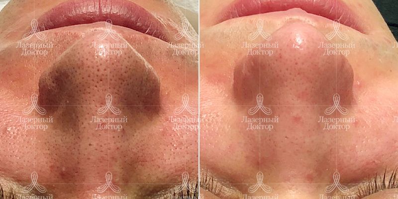 чистка до и после