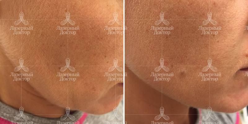 мезонити фото