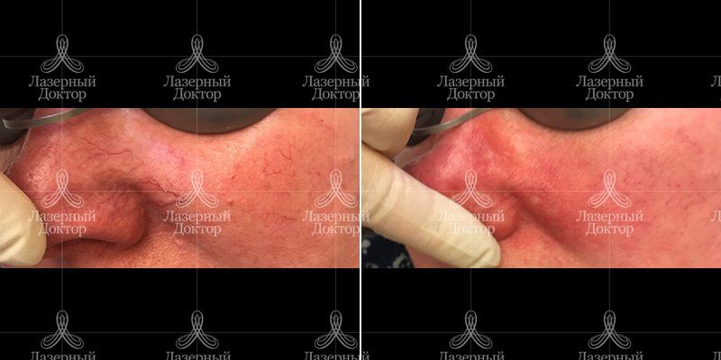 Удаление сосудов