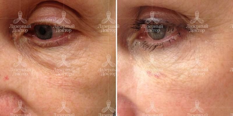 Контурная пластика носослезных борозд