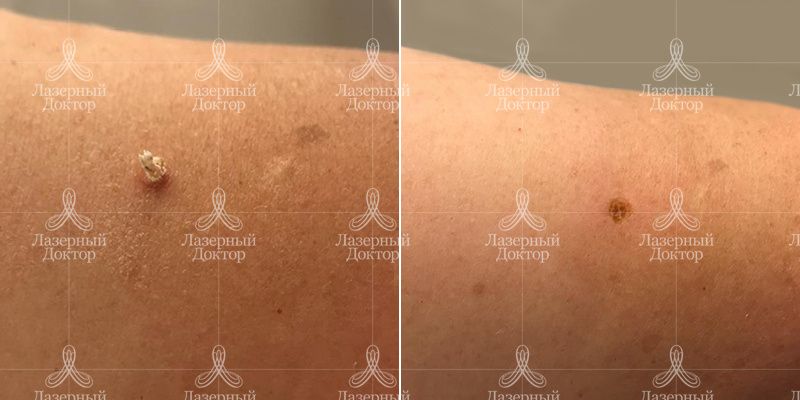 удаление новообразований