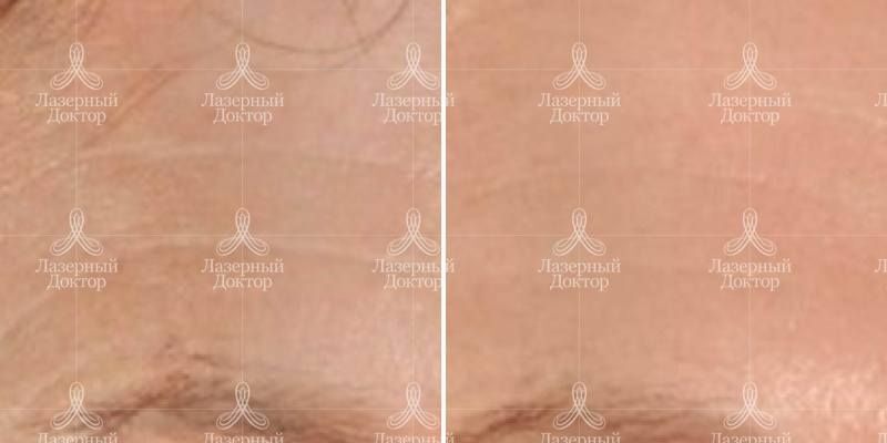 infini 3d лифтинг