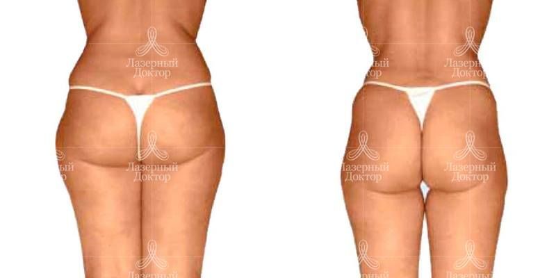 лпж массаж (фото)