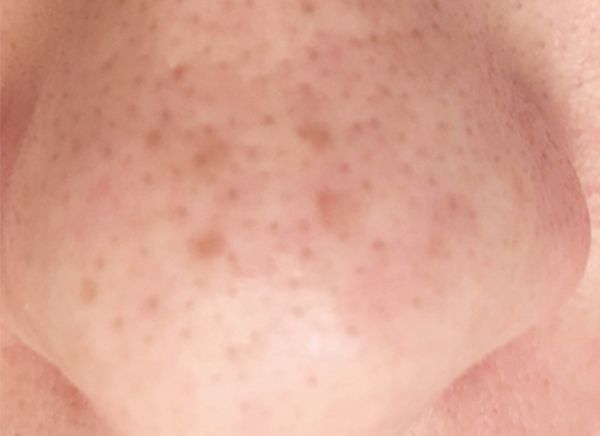 Ультразвуковая чистка лица фото до и после