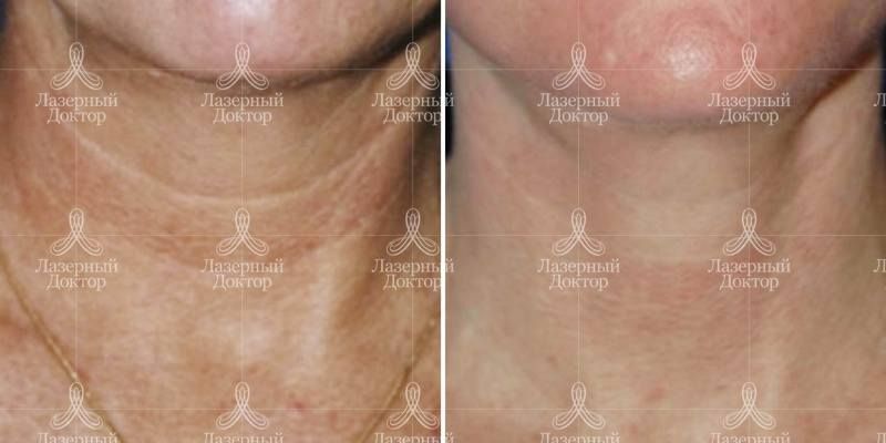 Омоложение Фраксель