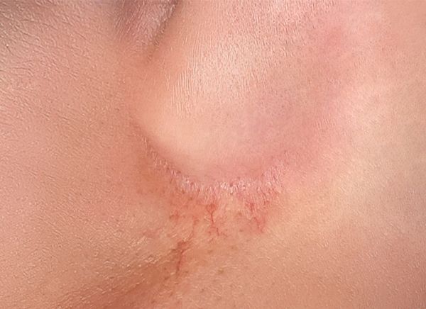 Удаление сосудов фото до и после