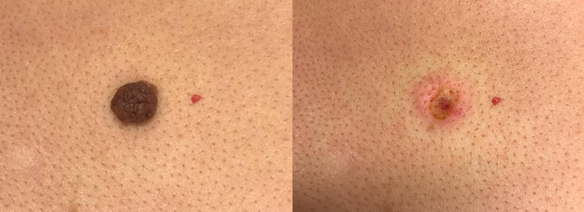 удаление новообразования