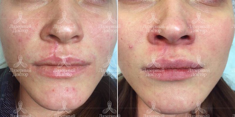 Контурная пластика рубец