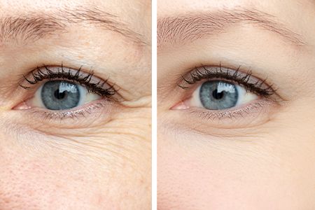 Фракционное омоложение кожи вокруг глаз